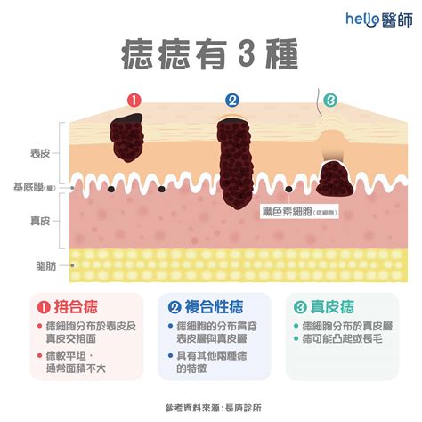 痣 生成原因|痣變大、痣多或長毛會變皮膚癌？認識痣的形成與原因